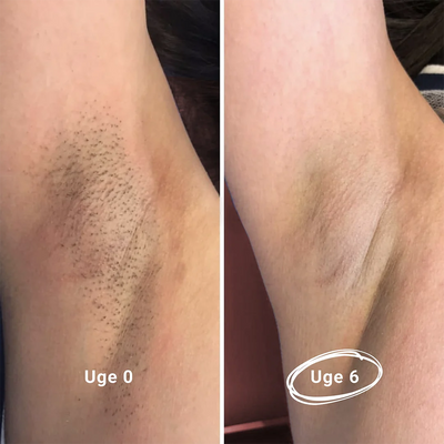 IPL & Scrub (PAKKETILBUD)