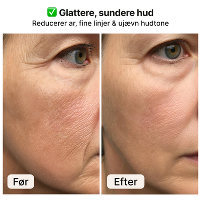 Derma stamp – Mikronåle til hud og hårvækst
